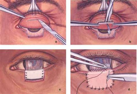 Hughes graft was dissected from tarsal conjunctival graft